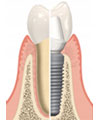 implant